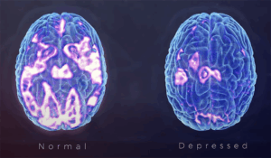 diagram of normal brain vs. depressed brain