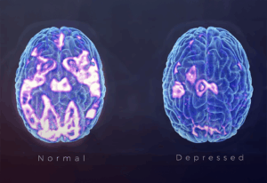 Normal vs. depressed brain diagram